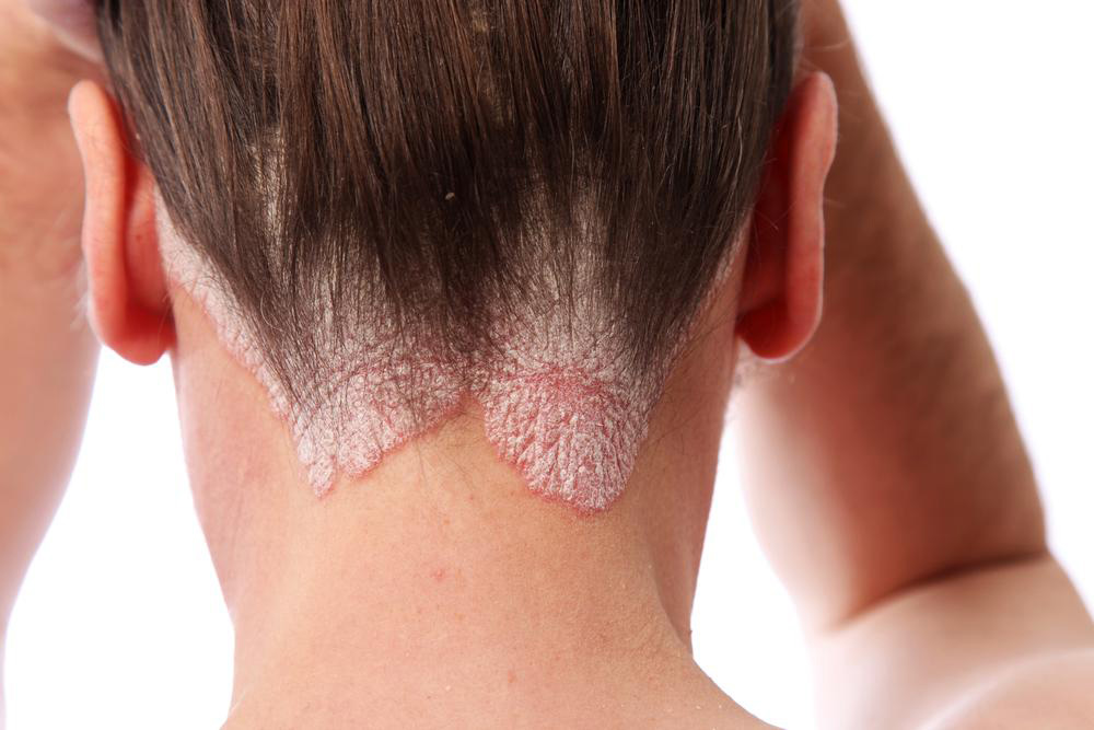 Know the skin ailment: Scalp psoriasis