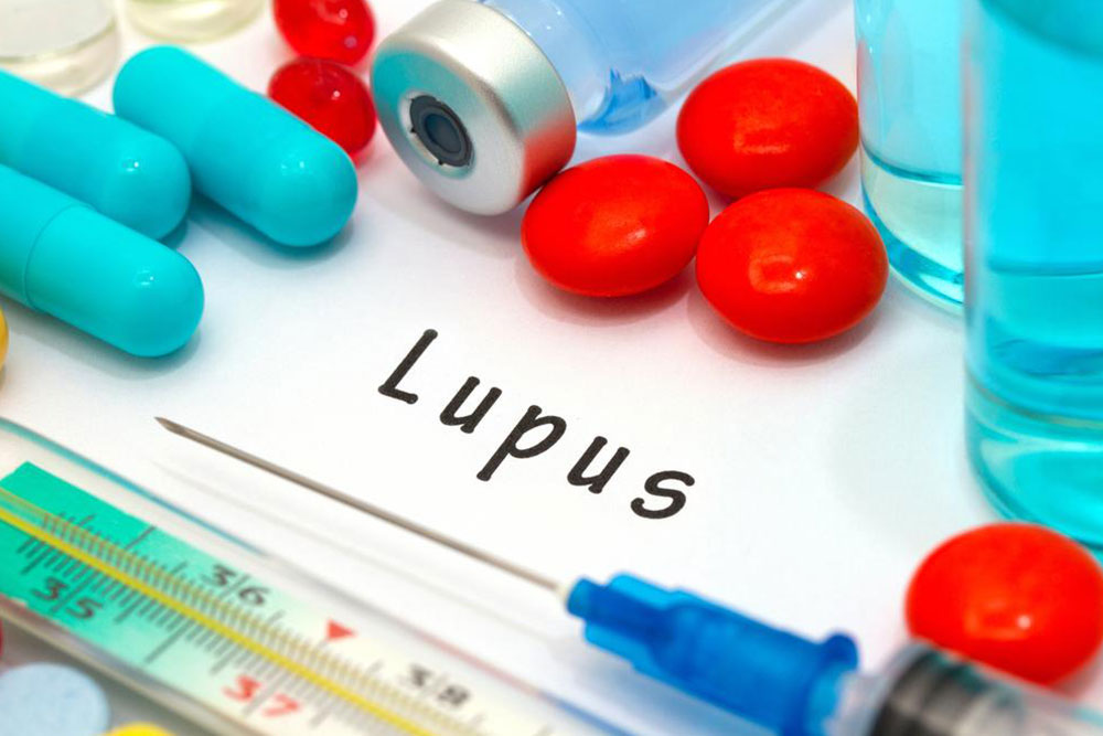 Remedies for Lupus