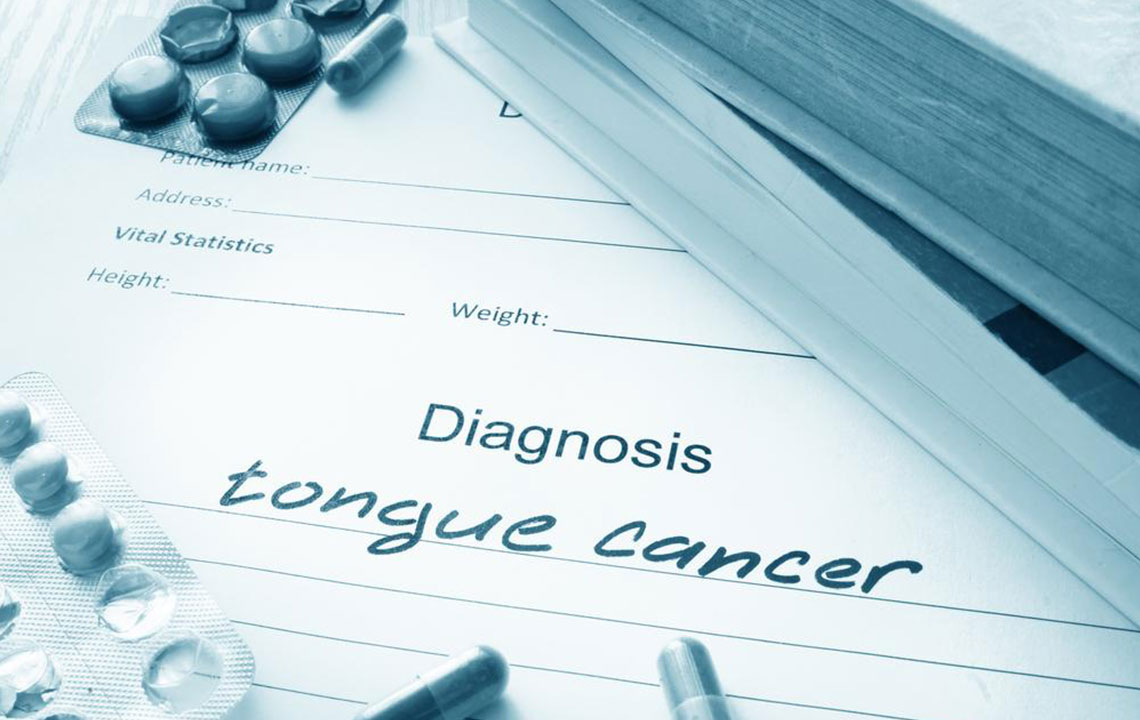 Symptoms of tongue cancer you should not ignore