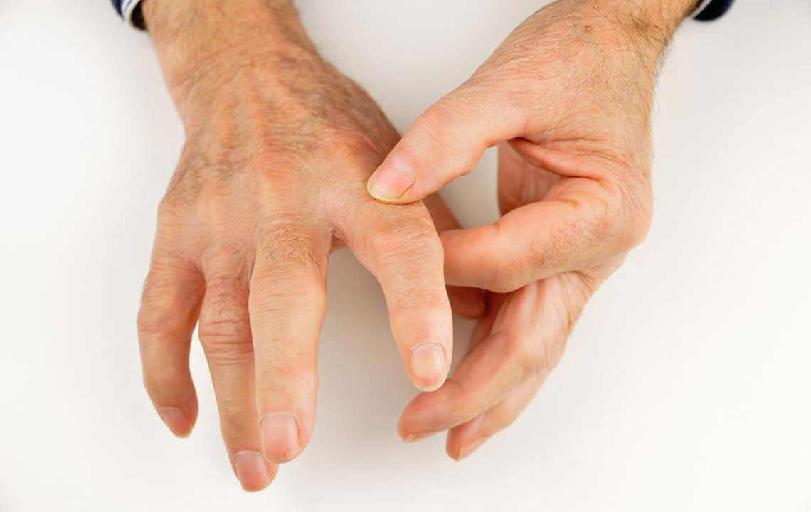 Popular Treatment Options for Rheumatoid Arthritis and Gout