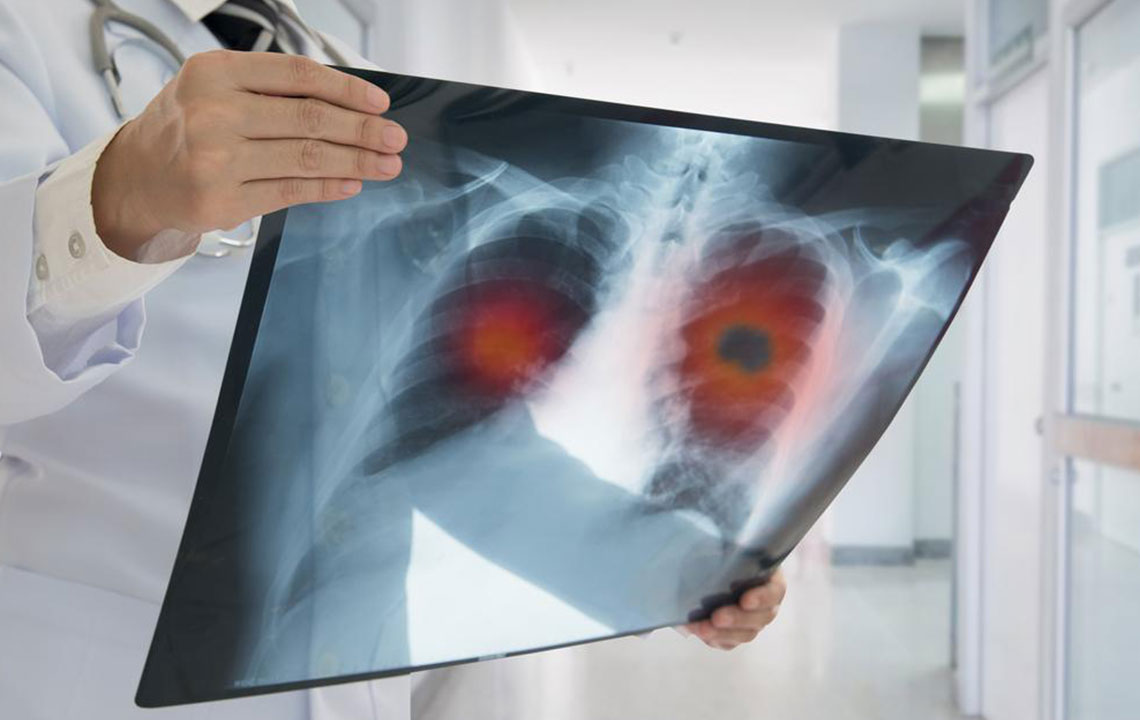 Symptoms and Treatments for Non-Small Cell Lung Cancer