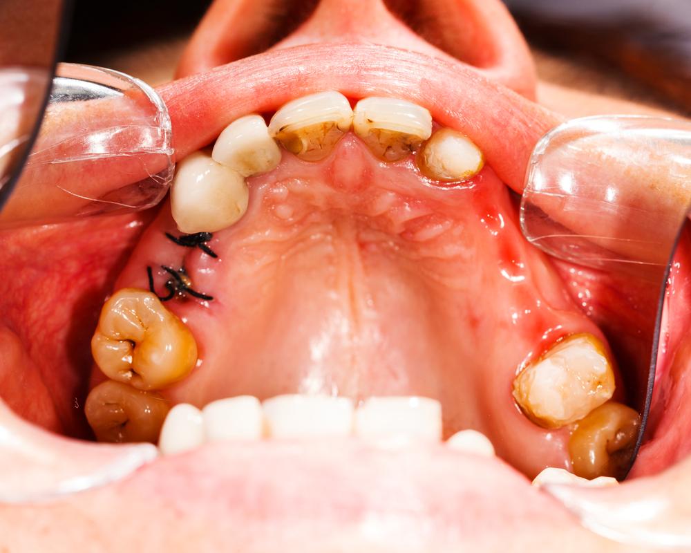 Effective Home Remedies to Treat Cavities