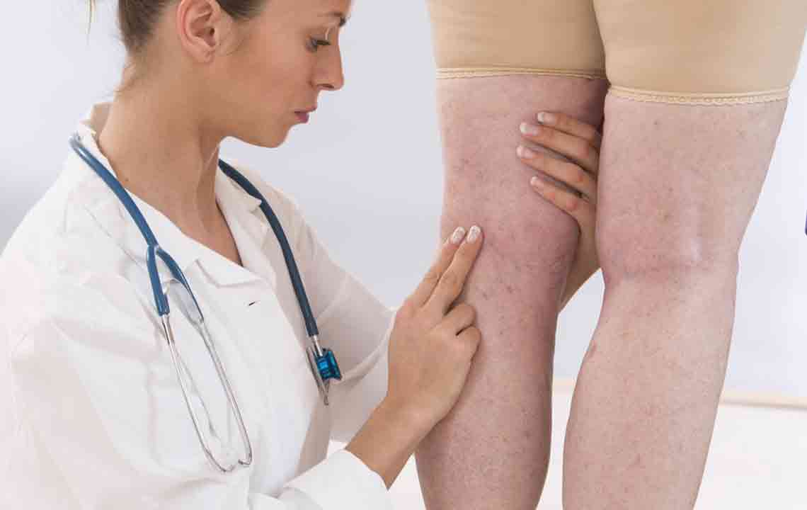 Various Symptoms of Deep Vein Thrombosis Worth Knowing